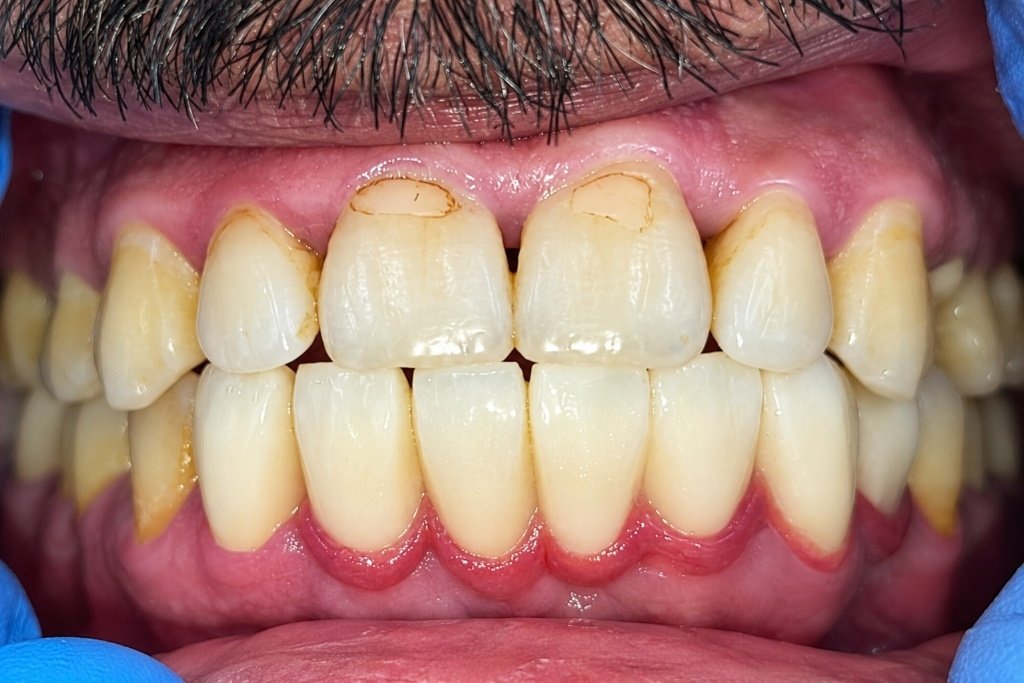 Smile After Treatment