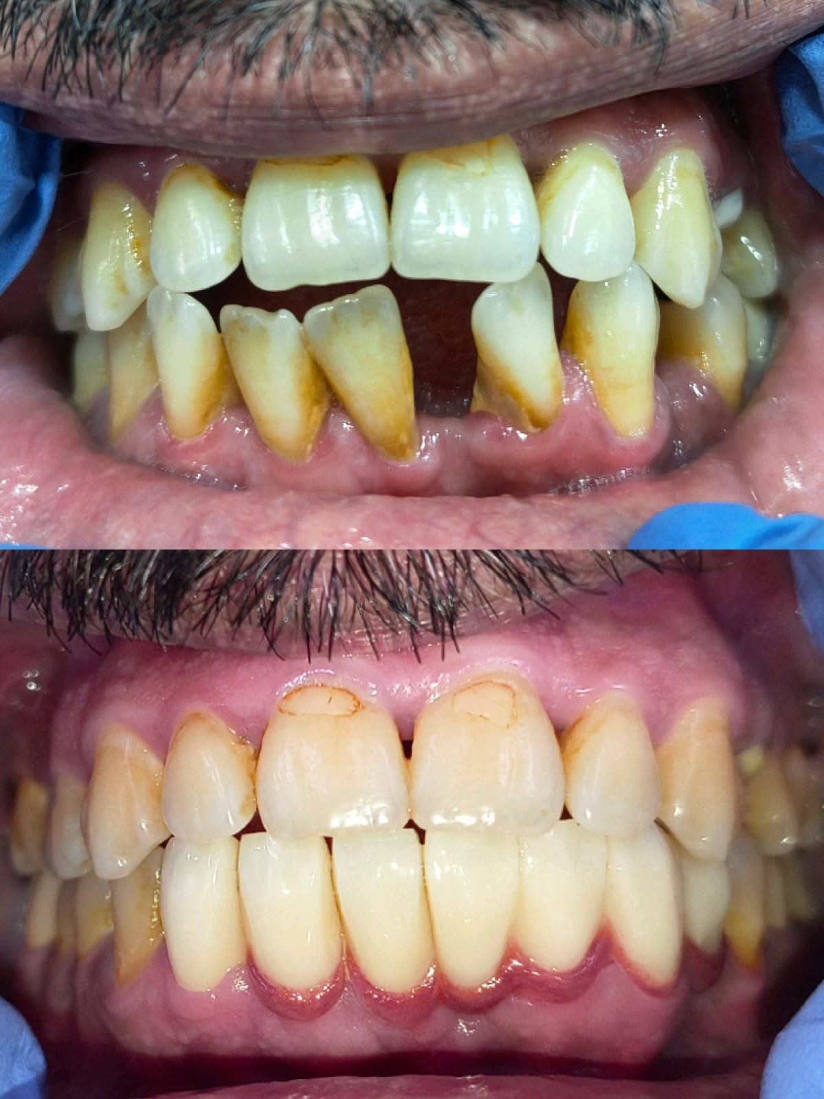Clinical Case 12 - Smile Symmetry