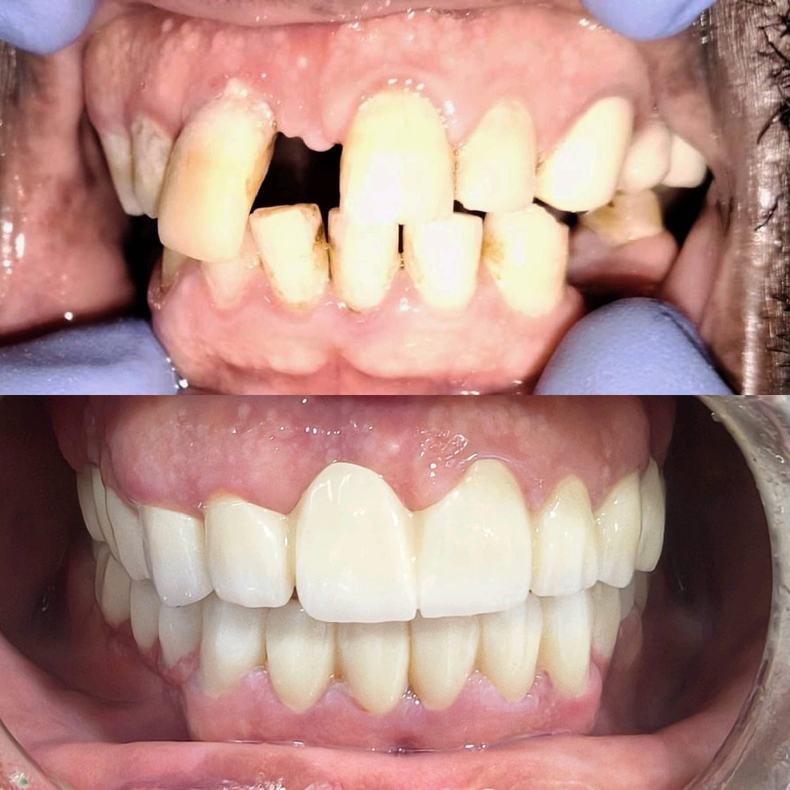 Clinical Case 13 - Prosthodontics