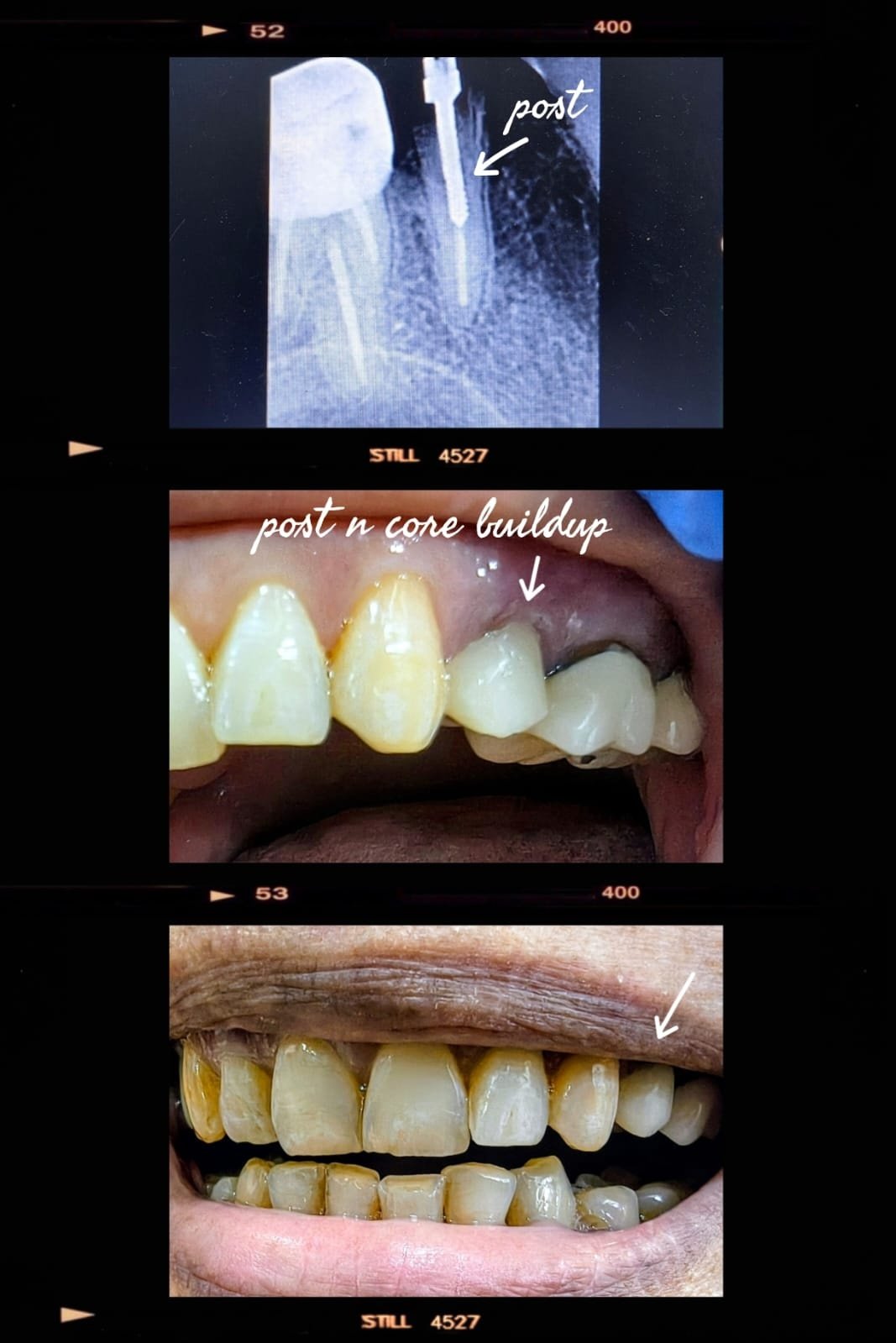 Clinical Case 15 - Root Canal