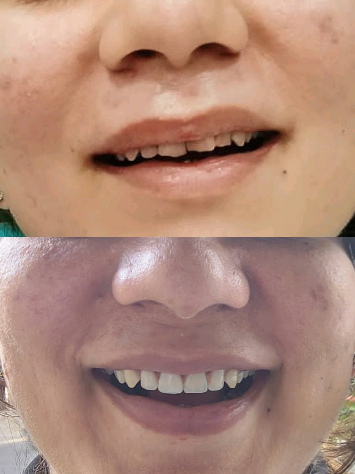 Clinical Case 16 - Cosmetic Dentistry